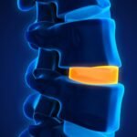 Get top-quality treatment for spine degeneration in Dubai with Dr. Challali Maxime. Advanced care for lumbar and cervical conditions.