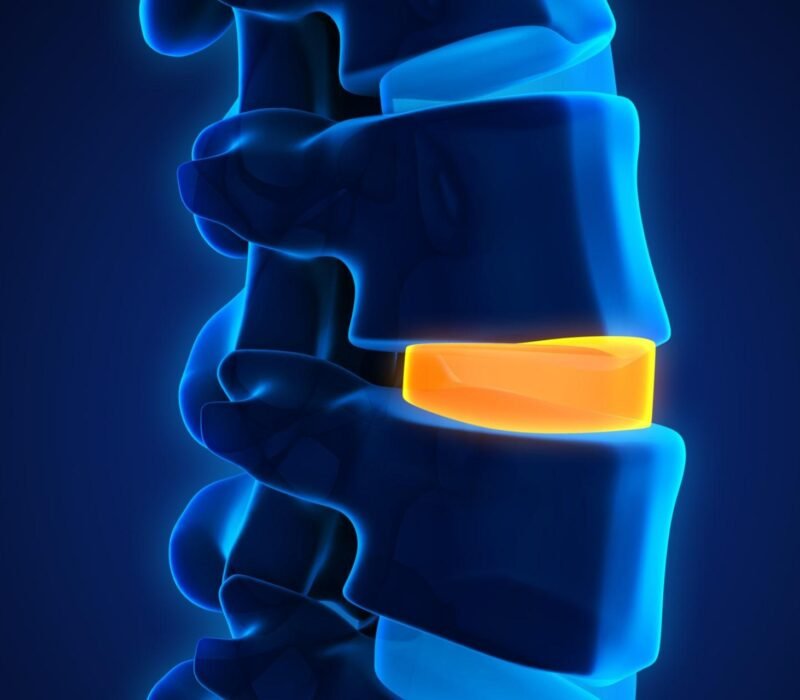 Get top-quality treatment for spine degeneration in Dubai with Dr. Challali Maxime. Advanced care for lumbar and cervical conditions.