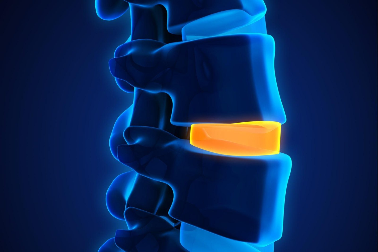 Get top-quality treatment for spine degeneration in Dubai with Dr. Challali Maxime. Advanced care for lumbar and cervical conditions.