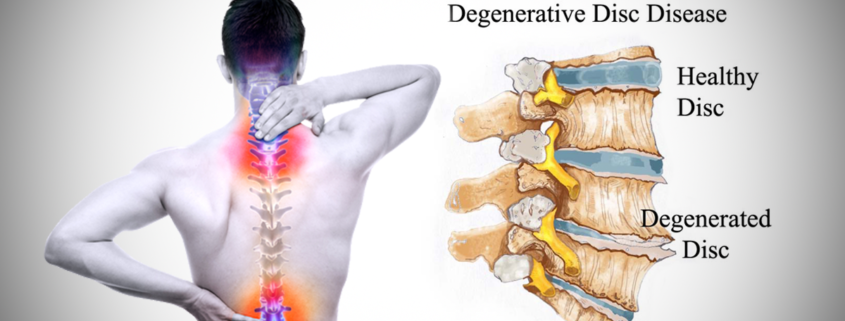 Comprehensive lumbar and cervical degeneration treatments in Dubai by Dr. Challali Maxime. Achieve optimal spine health with specialized care.